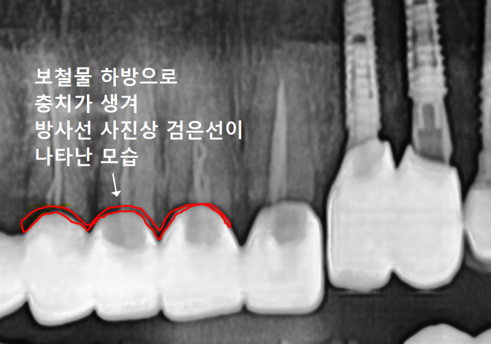 고덕동 어금니 브릿지 교체, 관련 이미지 2