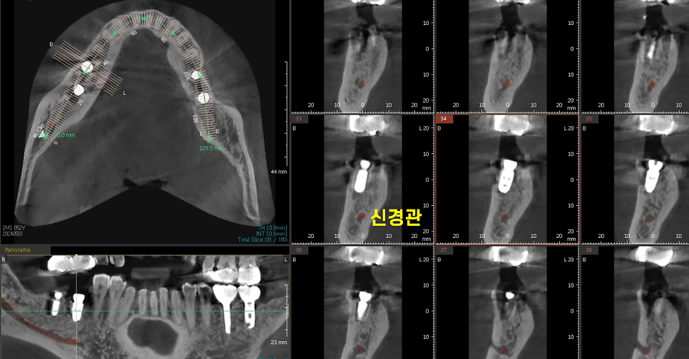 치아뿌리 염증 통증 유무 상관없이 치료를 받아야하는 이유 관련 이미지 6