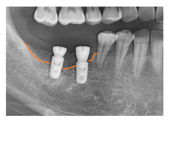 고덕동 임플란트 골이식 필수일까? 궁금증 여기 모두 있어요 관련 이미지 6
