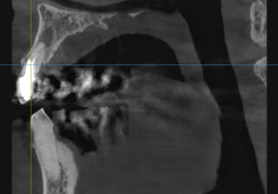 아스피린 복용 중인데 임플란트 수술, 가능할까요? 아스피린 얼마나 끊어야 하나요? 관련 이미지 5