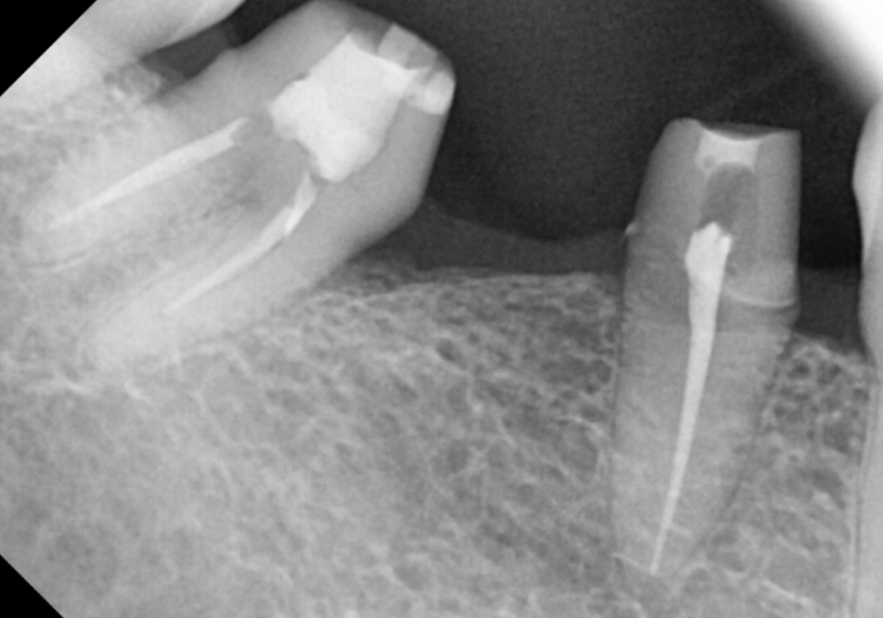 발치 후 빈 공간, 이 빼고 오래 냅두면 이렇게 됩니다. 관련 이미지 7