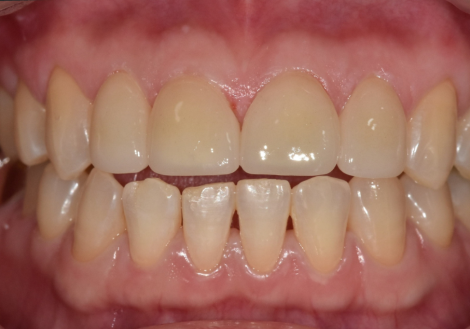무삭제 라미네이트 적응증, 당신이 미처 몰랐던 시술의 조건을 공개합니다. 관련 이미지 11