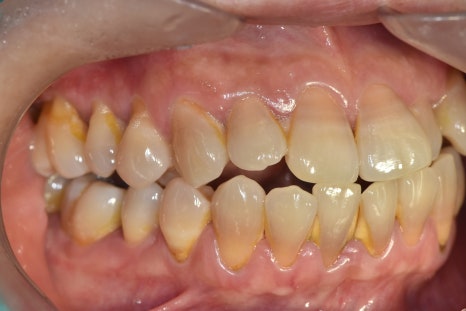 Gangdong-gu Dental Clinic: I Gag So Easily That I’m Too Afraid to Go to the Dentist. Tips to Reduce Gagging image 2