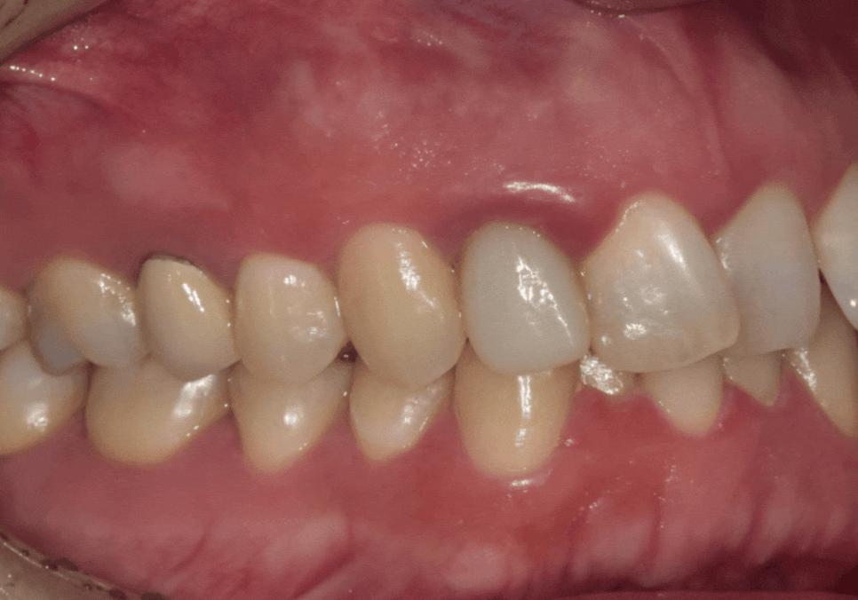 앞니 덧니, 교정은 싫고 시간은 없다면? 라미네이트로 해결한 사례 관련 이미지 6