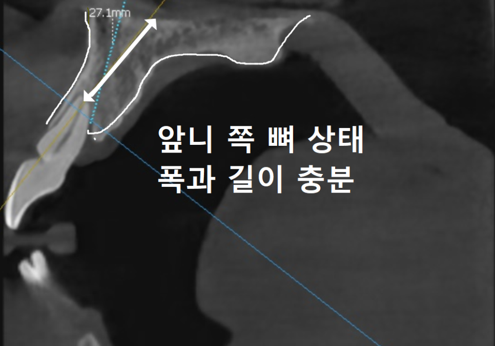 위 턱 전체 임플란트 vs 부분 틀니, 나에게 꼭 필요한 치료법 찾기 관련 이미지 8