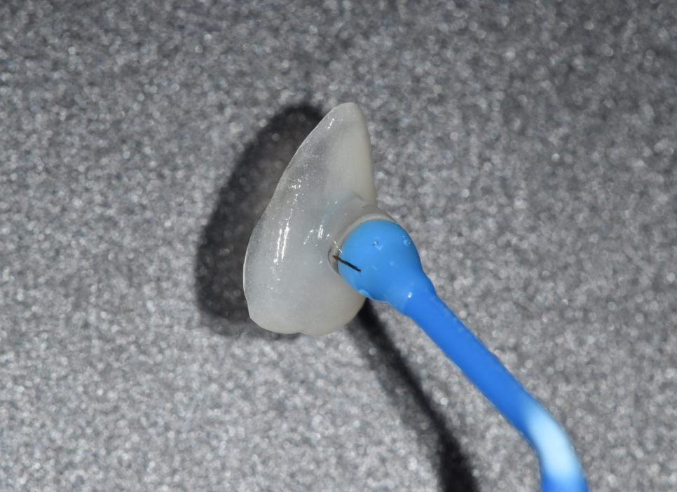 상일동역 라미네이트 치아 무삭제 정말 가능한가요? 관련 이미지 2