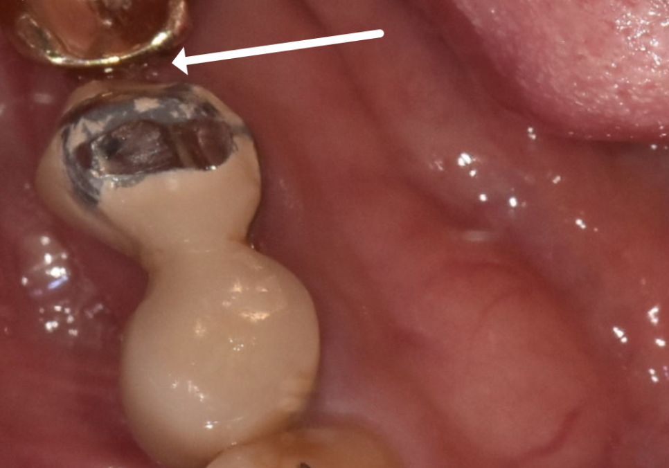 오래된 임플란트, 흔들림과 통증, 어떻게 하면 더 건강하게 쓸 수 있을까? 관련 이미지 4