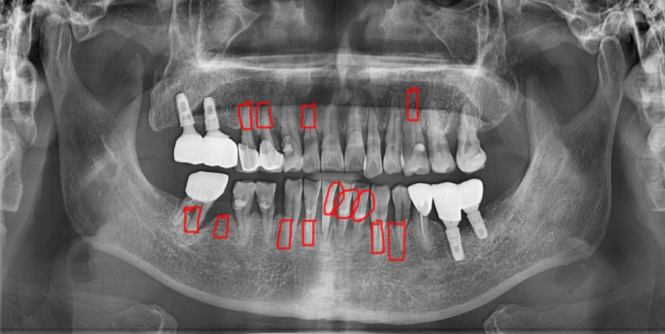 녹아버린 잇몸뼈 흔들리는 여러 치아 발치 후 임플란트 시행 관련 이미지 6
