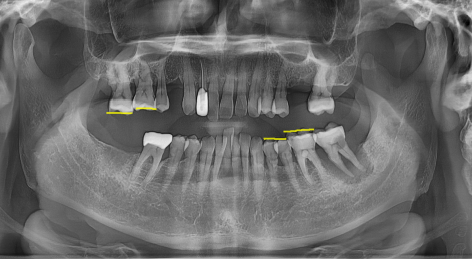 치아 상실 치료 치과 브릿지? 임플란트? 무엇이든 시도하세요. 관련 이미지 4
