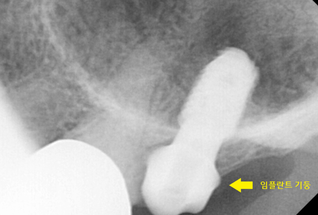 미사역 치과 어금니 뿌리 쪼개짐으로 발치 후 임플란트 했습니다! 관련 이미지 7