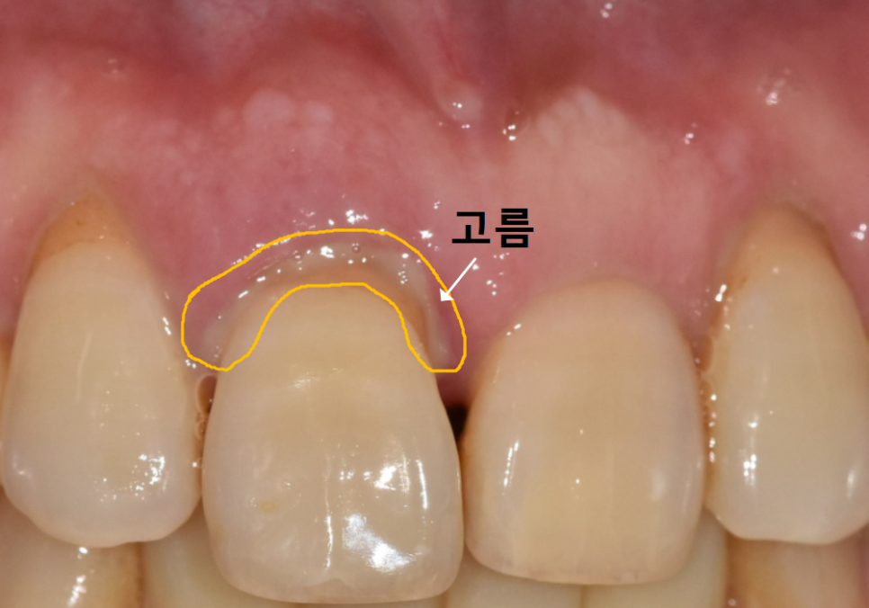 앞니 길어짐, 위 앞니가 점점 내려온다면? 관련 이미지 6
