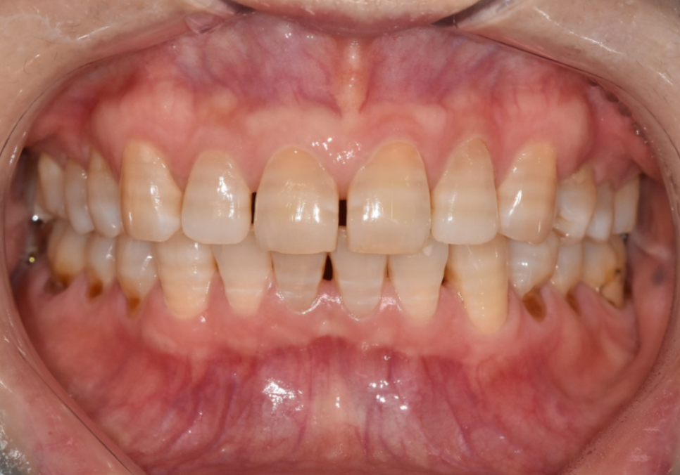앞니 변색, 치아미백효과 없는 이유 솔직하게 말씀드립니다. 관련 이미지 4