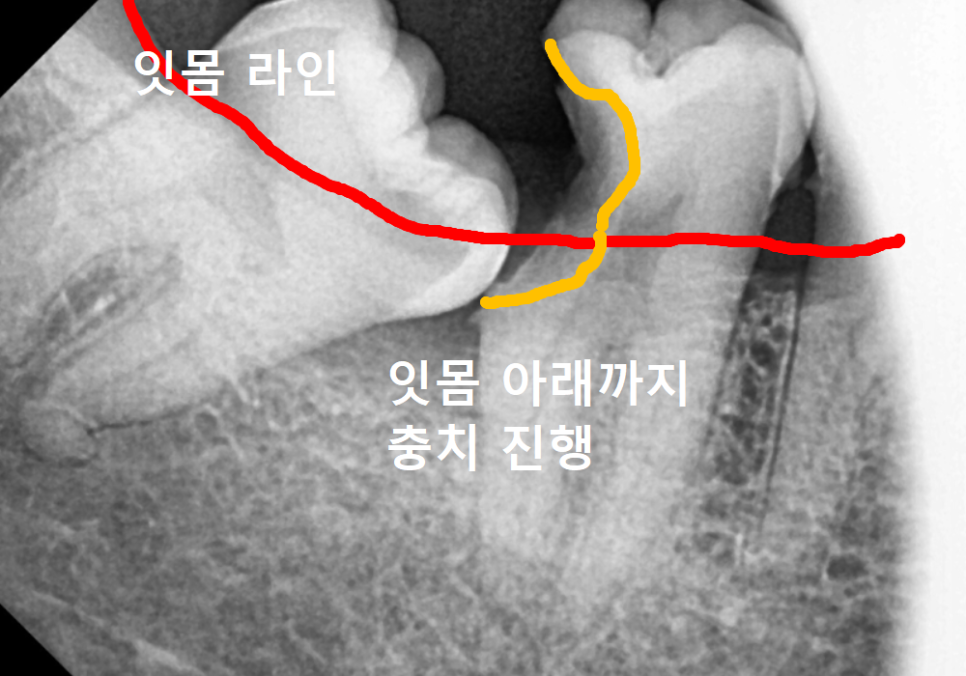 수평 매복 사랑니, 옆으로 누운 사랑니 때문에 멀쩡한 어금니까지 뽑은 사연 관련 이미지 7