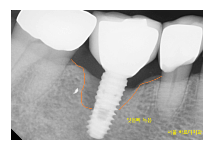 고덕동 치과 심한 치주염에는 oooo 치료가 제격입니다!! 관련 이미지 6
