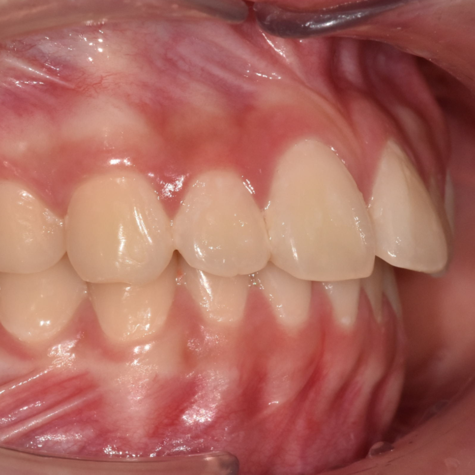 Can Protruding Mouth Be Corrected with Orthodontics Alone, Without Surgery? Sangil-dong Orthodontic Clinic image 7