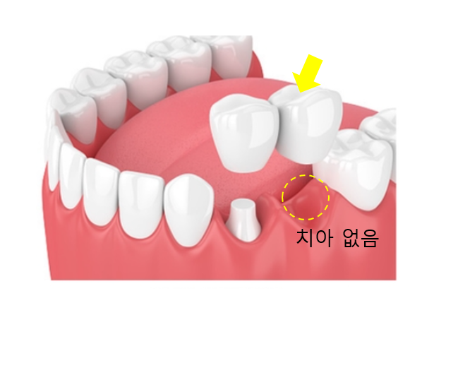 치아 닿기만 해도 아픔 원인은?? 해결은 이렇게 했습니다 관련 이미지 4