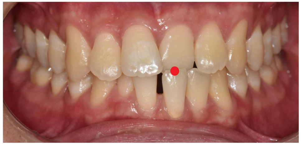 고덕역 교정치과 성인 부정교합 위아래가 거꾸로 물릴때는? 관련 이미지 2