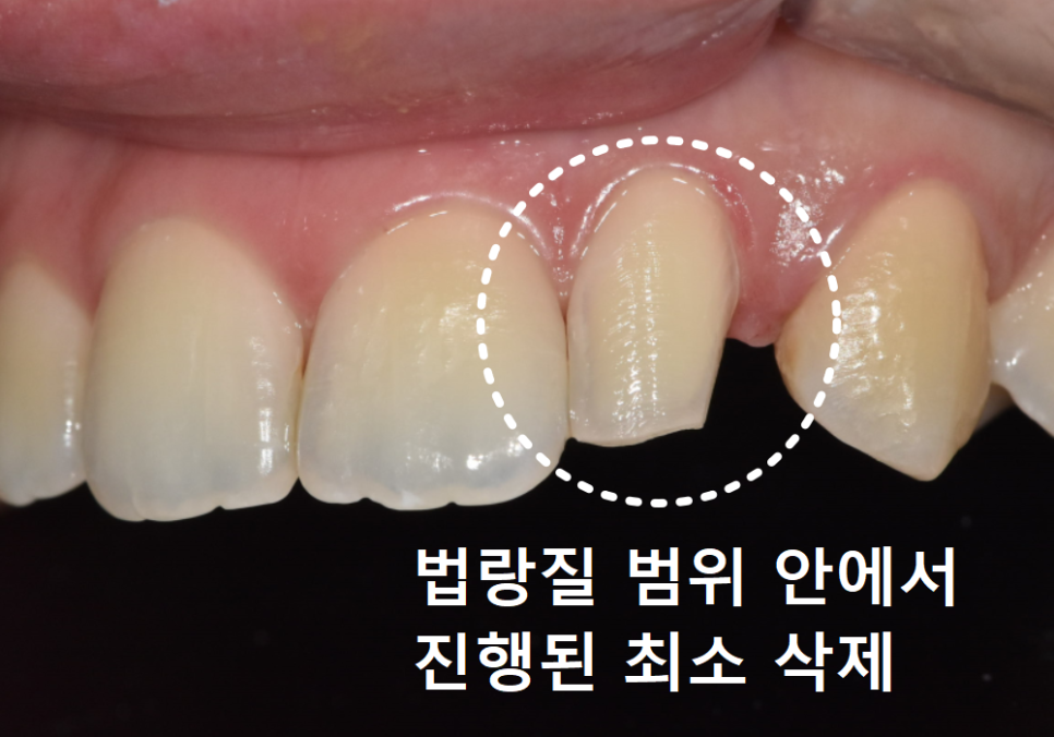상일동역 라미네이트, 왜 누군가는 부작용을 겪고, 누군가는 10년 넘게 멀쩡할까? 관련 이미지 7