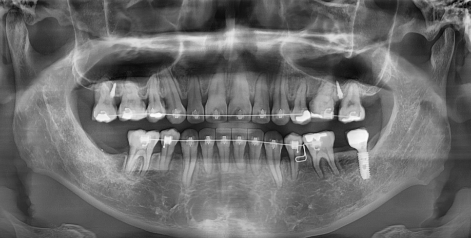 교정 철사 교체 와이어 왜 자꾸 갈까? 주기는? 관련 이미지 3