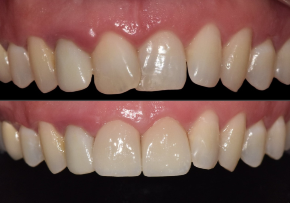 앞니 덧니, 교정은 싫고 시간은 없다면? 라미네이트로 해결한 사례 관련 이미지 14