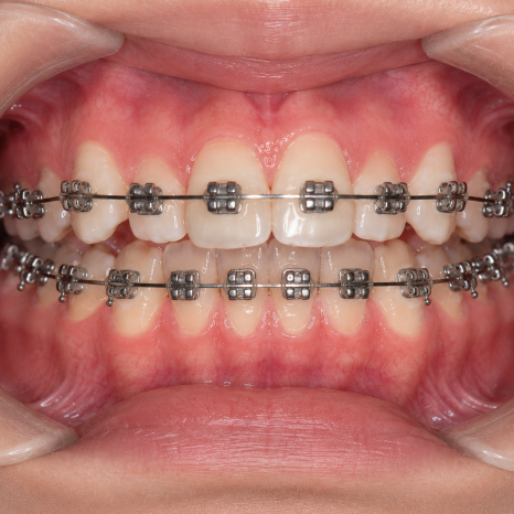 Why Does My Mouth Look More Protruded During Orthodontic Treatment, and When Will It Improve? image 2