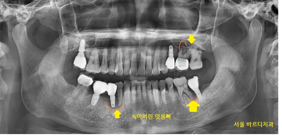 고덕동 치과 임플란트 뼈이식 꼭 해야하는건가요? 관련 이미지 3
