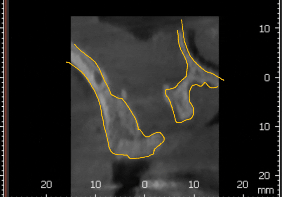 Sinusitis Caused by Teeth: Why Do You Tell Me to Go to the Dentist When My Nose Hurts? image 9