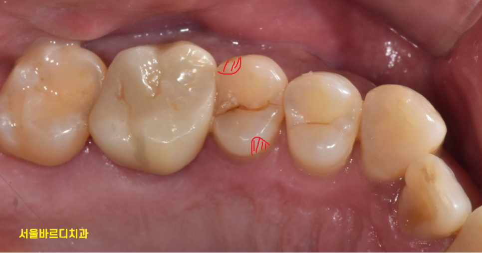풍산동 치과 어금니 쪼개짐 임플란트를 해야할 때는? 관련 이미지 6