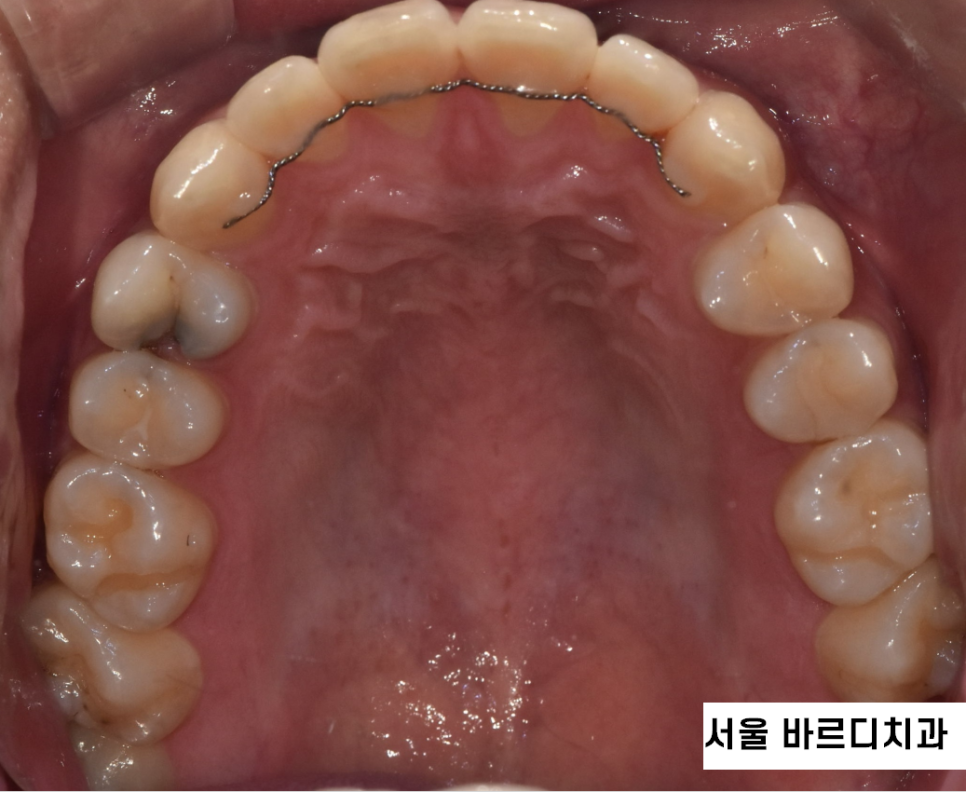 투명교정 치료 과정 이렇게 진행됩니다! 집에서 장치를 받아요! 관련 이미지 6