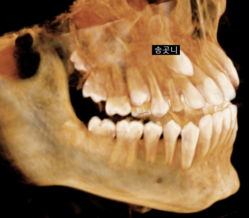 Pediatric Orthodontic Treatment for Impacted Canines Is Needed to Guide Proper Eruption. image 5