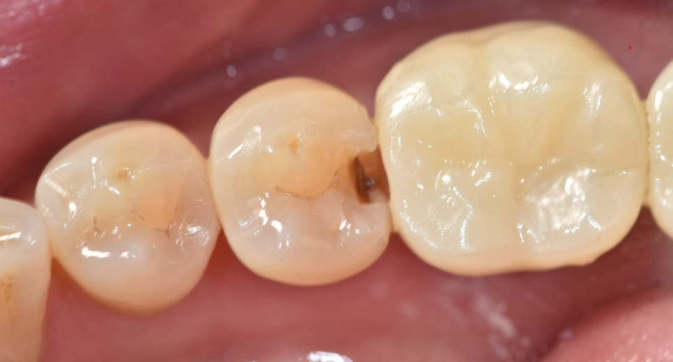 어금니 치아 파절 부러짐 발치까지 이어질 수 있습니다. 관련 이미지 5