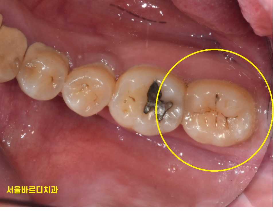 길동 치과 검은 점 충치 검정색이라고 다 치료할 필요는 읎다! 관련 이미지 4