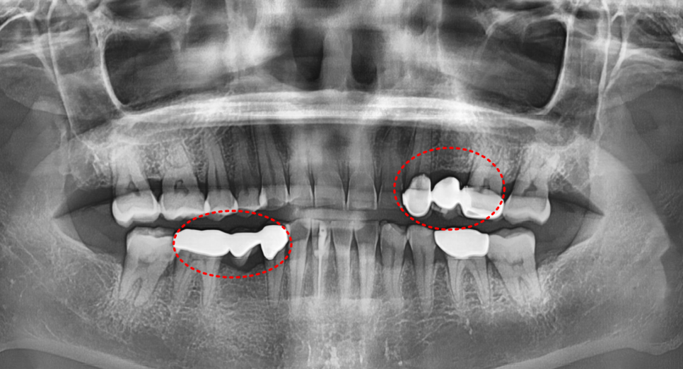 누런 치아 연예인치아 처럼 하얗게 만들 수 있나요? 관련 이미지 6