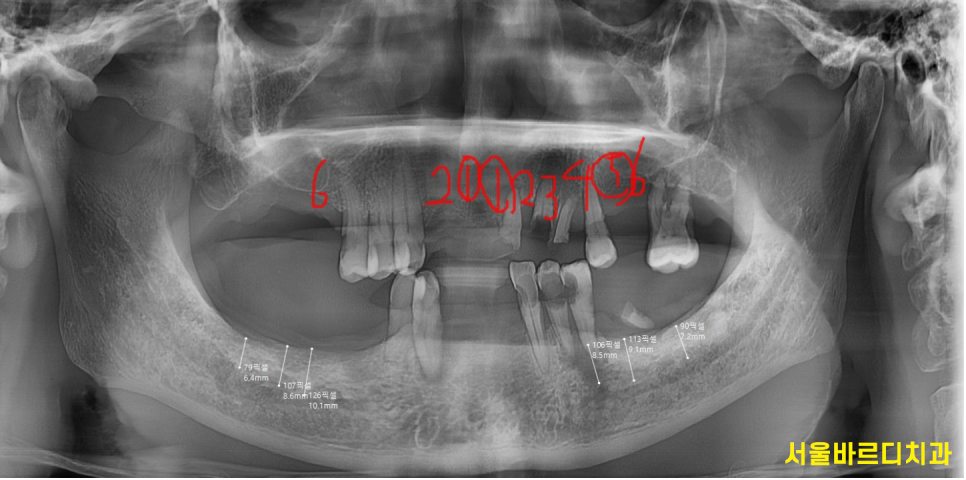 상일동 임플란트 잘하는곳 치료는 이렇게 진행됩니다. 관련 이미지 6