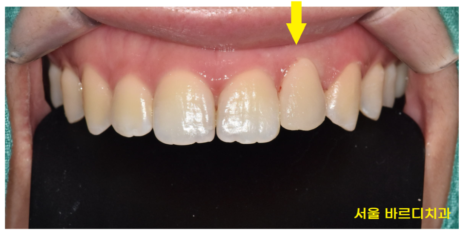 앞니 레진 변색으로 무삭제 라미네이트 진행했습니다. 관련 이미지 8