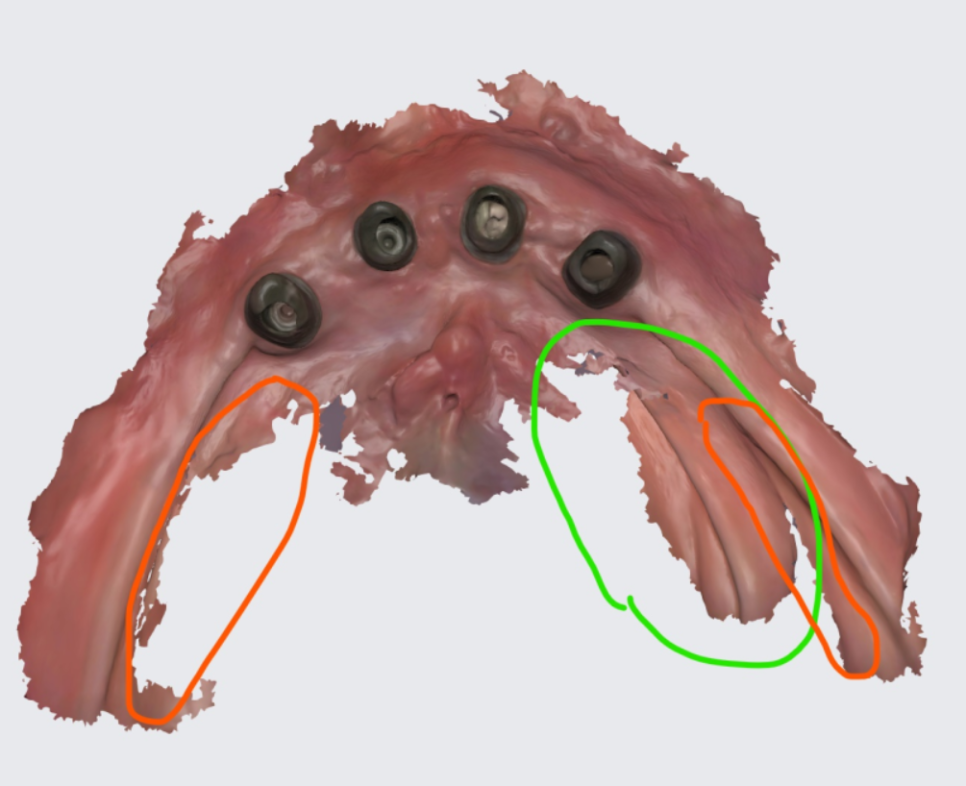 상일동 근처 치과 얇은뼈 틀니 안될 때 해결 방법은?? 관련 이미지 8