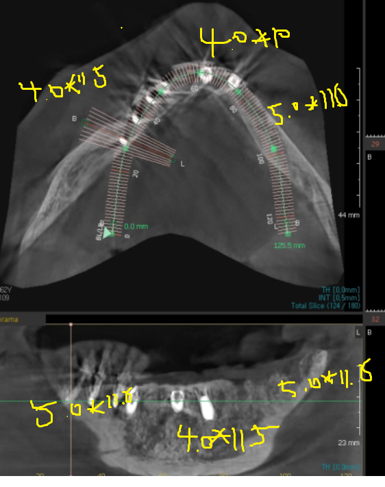 고덕역  치과 틀니쓰다 위아래 전악 임플란트 재건했습니다. 관련 이미지 7