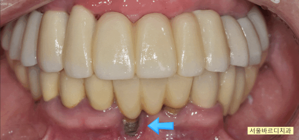 상일동 치과 부분 틀니에서 임플란트 바꿔서 사용하기 관련 이미지 1