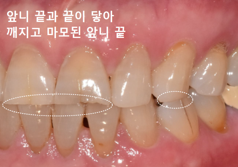앞니 세로 줄, 똑같은 금이라도 진단 결과가 180도 다른 이유 관련 이미지 10
