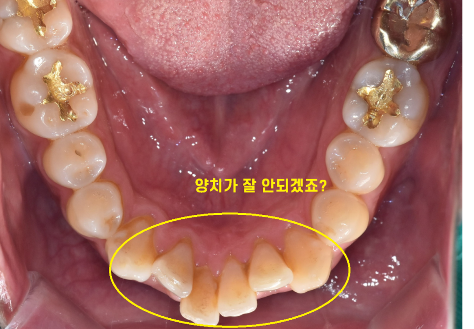 고덕역 교정치과 40대인데 치아 교정 가능한가요? 관련 이미지 3