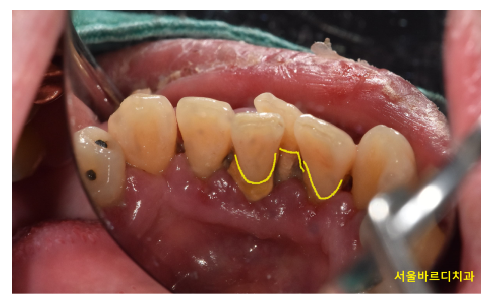 강동구 스케일링 받고 꼭 필요한 한 가지 불소 관련 이미지 2