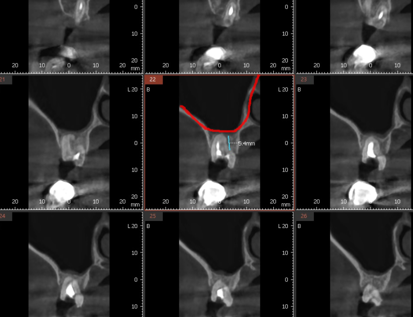 보철 부러짐 발생으로 치아 뿌리만 남았을 때 치료 방법 임플란트 관련 이미지 7