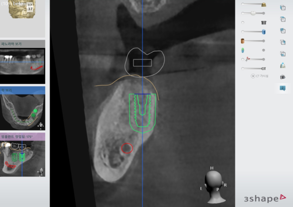 천호동 치과 무절개 임플란트 비교하고 결정하세요 관련 이미지 6