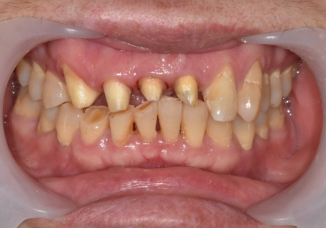 고덕동 심미 보철, 삐뚤어진 앞니, 교정 없이 바로잡은 비결 관련 이미지 10