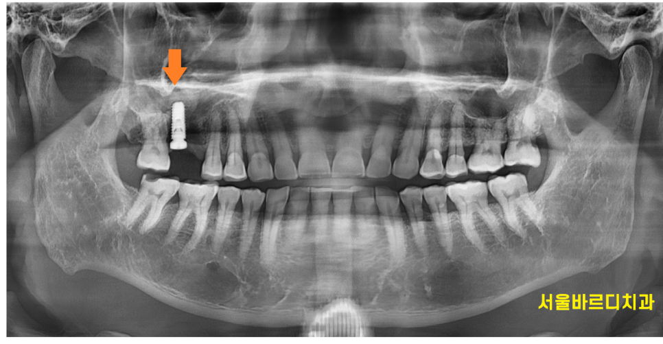 망월동 치과 염증이 심하면 임플란트 바로 못심어요 잇몸뼈 함몰 케이스 관련 이미지 8