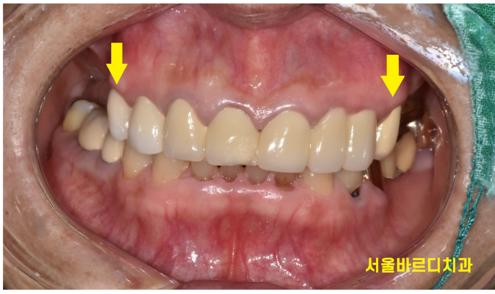 하남 임플란트 치과 주문진에서부터 치료 받으러 오신 환자분 관련 이미지 3