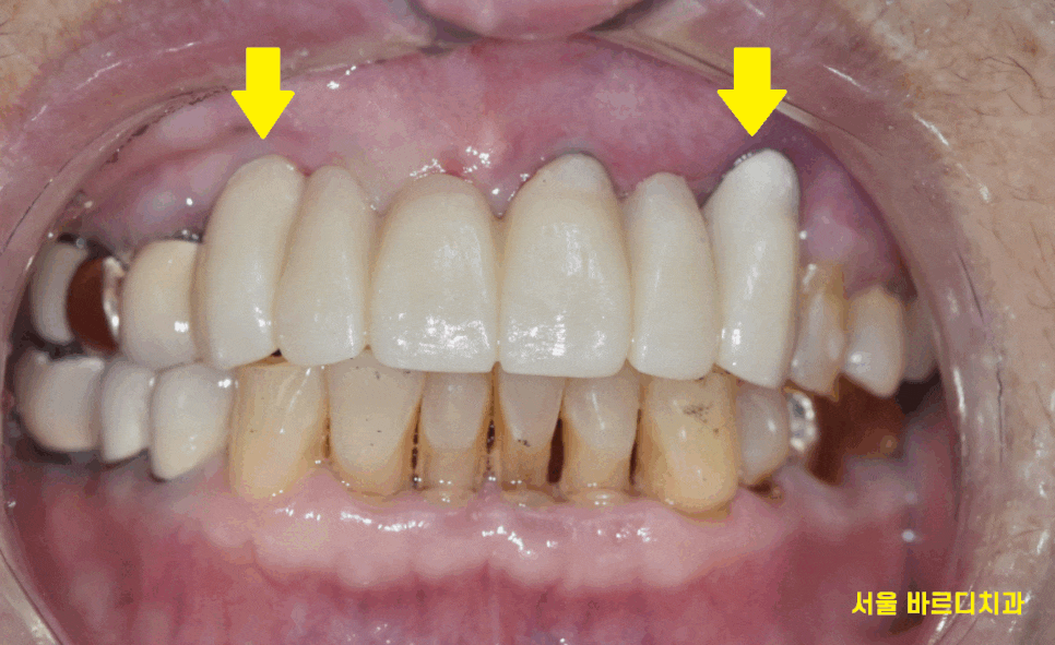 하남미사치과 앞니 브릿지를 임플란트로 교체했습니다. 관련 이미지 1