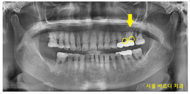 치아 크라운 빠짐 살릴 수 없을 때 강일역 임플란트 관련 이미지 2
