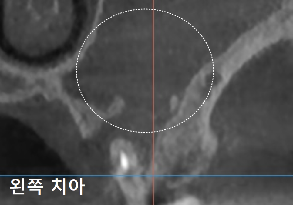 Sinusitis Caused by Teeth: Why Do You Tell Me to Go to the Dentist When My Nose Hurts? image 8
