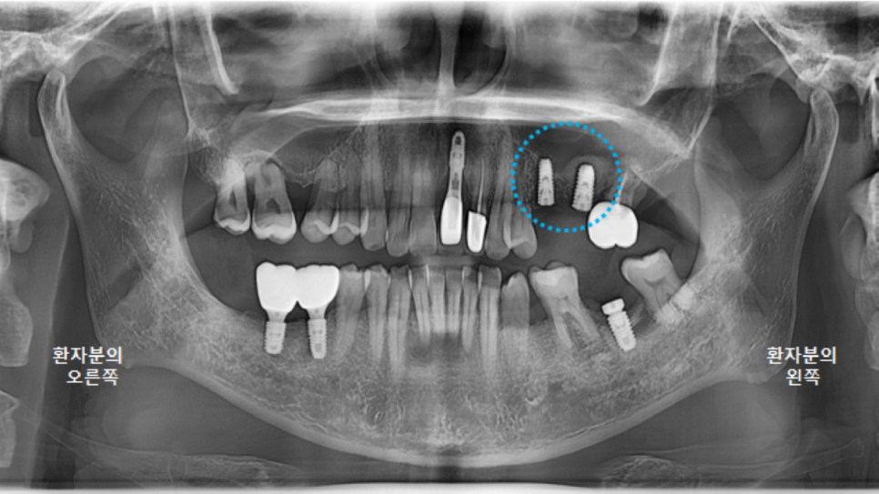 고덕동치과 서울바르디치과 전치부 및 구치부 임플란트 치료증례 #9 관련 이미지 23